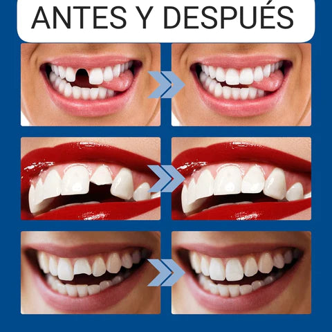 Moldable False Teeth ™ - Sonrisa Perfecta en Minutos
